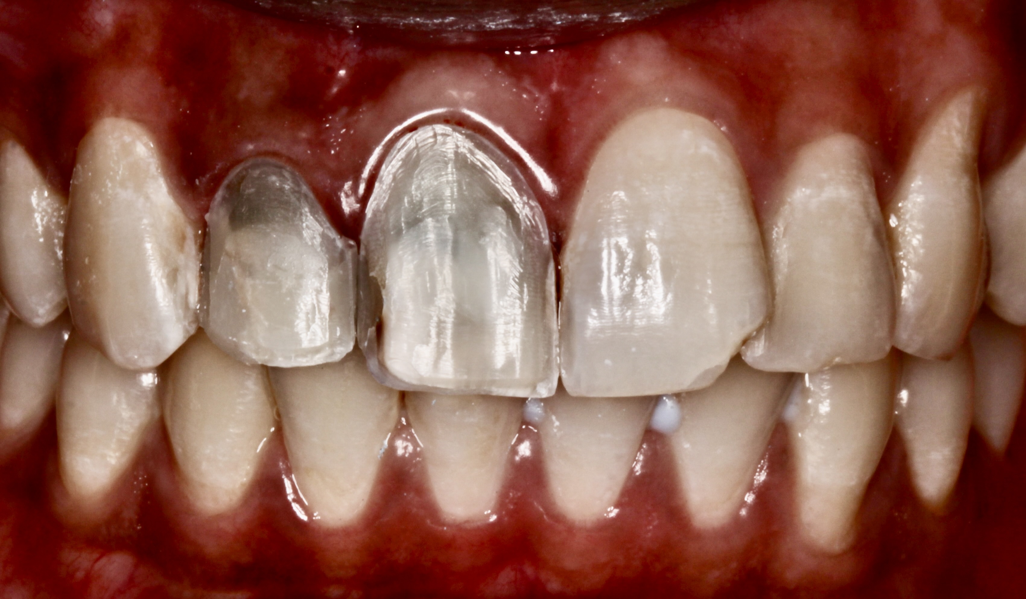 Veneer preparation